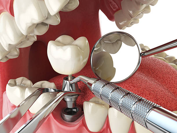 Best Emergency Dental Care for Broken or Chipped Teeth in Desert Aire, WA
